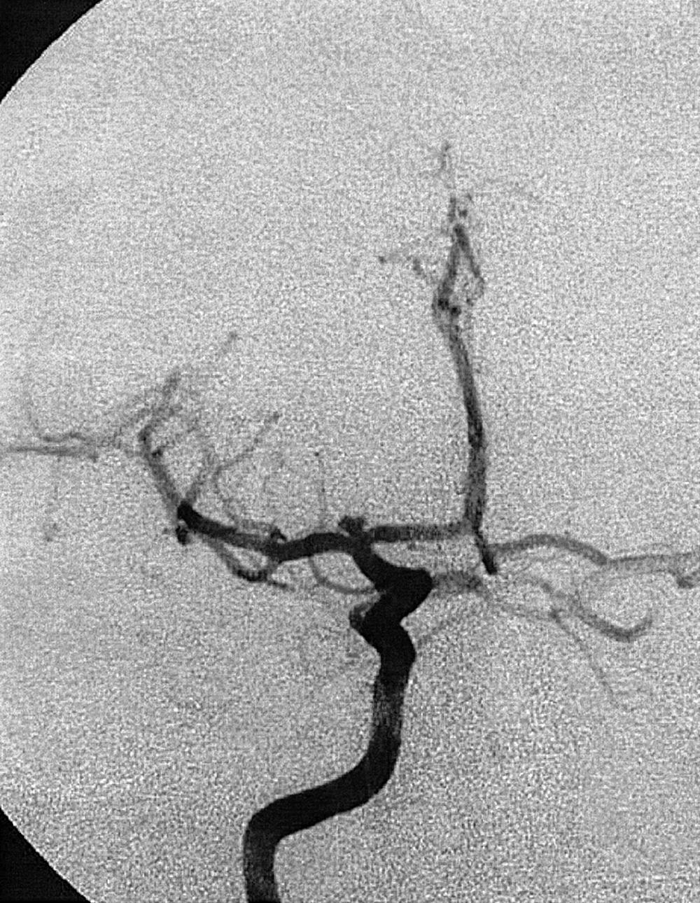 Fig. 49.10, Right internal carotid artery injection, anteroposterior projection, arterial phase, demonstrating a carotid bifurcation aneurysm. The aneurysm is bilobed and irregular in contour.