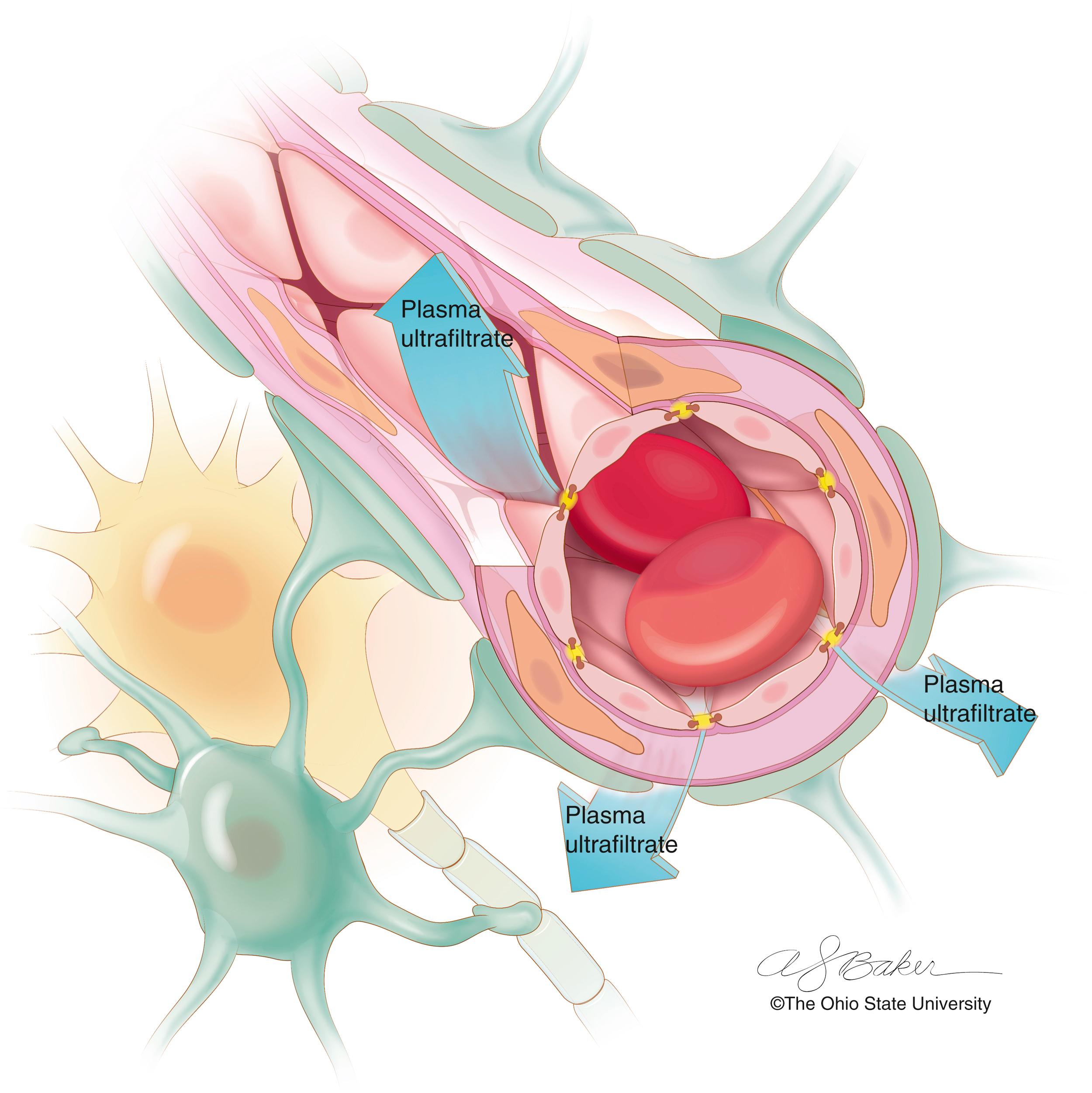 Figure 70.2, Illustration of blood-brain barrier derangements found in vasogenic edema.