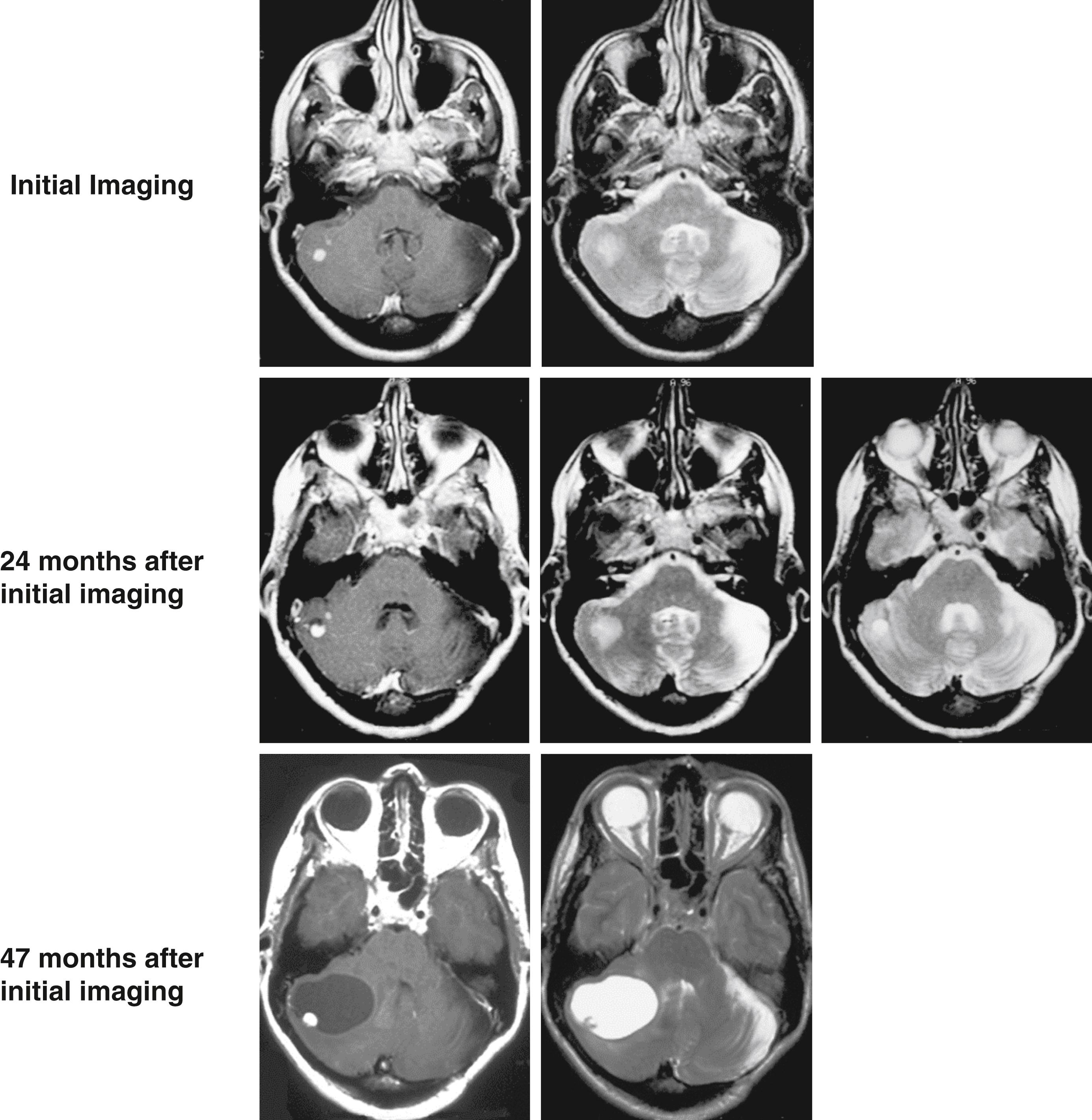 Figure 70.3, Serial axial MR images of a patient with a right cerebellar hemisphere that demonstrate peritumoral edema to cyst progression over 47 months.