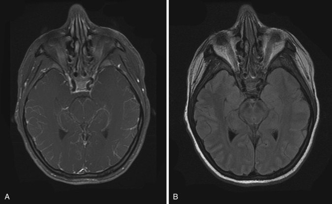 FIG 10-1, Meningitis. A, Contrast-enhanced MRI study shows enhancement along the leptomeninges in cerebral sulci bilaterally. B, Sulcal hyperintensities are seen bilaterally along the convexities of temporal and occipital lobes on this T2-FLAIR image.