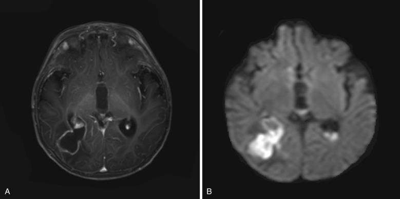 FIG 10-11, Abscess causing ventriculitis in a child. A, Gadolinium-enhanced MRI study shows a rim enhancing right peritrigonal abscess with rim enhancement rupturing into the right atrium. Ependymal enhancement is seen in the posterior right lateral ventricle, consistent with ventriculitis. Enlarged enhancing choroid plexus represents choroid plexitis. B, Diffusion-weighted images (DWI) demonstrate marked hyperintensity within the abscess cavity extending into the right lateral ventricle. Note the dependent DWI hyperintense debris in the left atrium. ADC images (not shown) confirmed diffusion restriction in these areas.