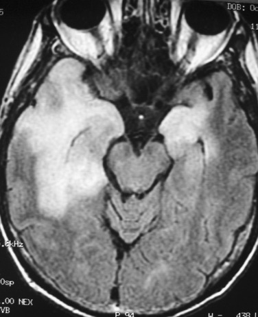 FIG 10-12, Herpes simplex virus (HSV)-1 encephalitis. Axial T2-FLAIR image shows hyperintense lesions in both temporal lobes, more on the right side.