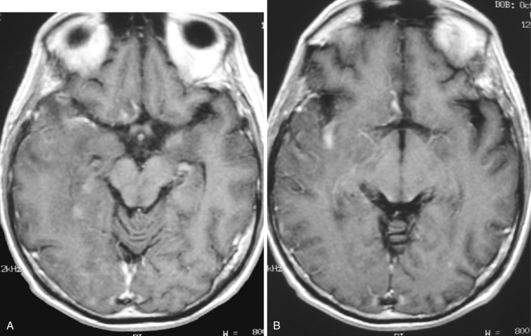 FIG 10-13, Herpes simplex virus (HSV)-1 encephalitis. Axial postcontrast T1-weighted image demonstrates linear streaky enhancement along the sylvian fissure, insular cortex, and bilateral temporal frontal gyri ( A, B ).