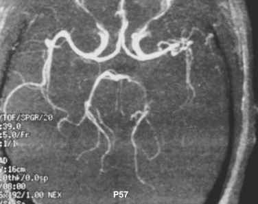 FIG 10-14, Herpes zoster vasculitis. MR angiogram demonstrates narrowing of the left middle cerebral artery branches as well as the proximal left posterior cerebral artery. There is a small infarct in the left middle cerebral artery territory.