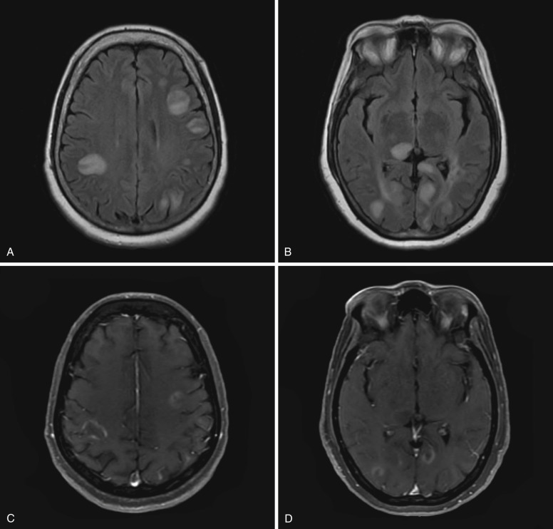 FIG 10-15, Acute disseminated encephalomyelitis (ADEM). A and B, T2-FLAIR images show numerous asymmetric rounded hyperintense, predominantly subcortical, white matter lesions. Some lesions involve the cortex. A right pulvinar lesion is also seen. C and D, Postcontrast T1-weighted image demonstrates incomplete ring enhancement associated with these lesions. All the lesions show similar imaging features. Marked improvement was seen after steroid therapy.