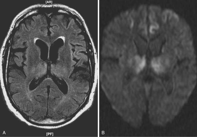 FIG 10-16, Creutzfeldt-Jakob disease. A, T2-FLAIR image demonstrates hyperintensity in both thalami, in the periatrial white matter, and in the anterior cingulate gyri. B, Diffusion-weighted image shows restricted diffusion in both thalami and cingulate gyri.