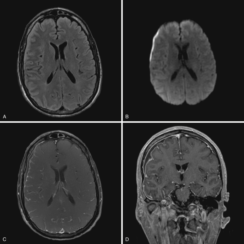 FIG 10-2, Subdural empyema. A, T2-FLAIR image demonstrates a right frontoparietal hyperintense subdural fluid collection. In addition, hyperintense fluid is seen in the adjacent cerebral sulci. The adjacent cortex is hyperintense. B, Diffusion-weighted image shows hyperintensity of the subdural collection. ADC (apparent diffusion coefficient) map confirmed restricted diffusion by demonstrating low ADC values in the collection. C and D, Axial and coronal postcontrast T1-weighted images show linear enhancement along the lateral and medial walls of the collection, with adjacent sulcal leptomeningeal enhancement.