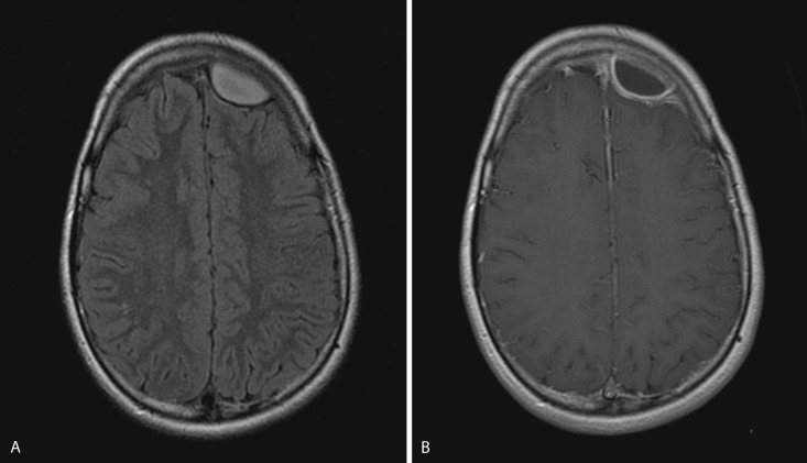 FIG 10-3, Epidural empyema. A, T2-FLAIR image demonstrates a left frontal lentiform hyperintense epidural fluid collection. A low signal rim is seen posteriorly, representing the dura. B, Postcontrast T1-weighted image shows rim enhancement of this collection. Notice the lack of leptomeningeal or parenchymal enhancement. There was restricted diffusion within the collection (not shown). This collection extended across the midline above the superior sagittal sinus (not shown).