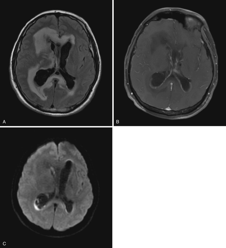 FIG 10-4, Ventriculitis. A, T2-FLAIR image demonstrates marked ventricular enlargement and periventricular parenchymal hyperintensity, most prominently on the right. B, Postcontrast T1-weighted image shows enhancement of the ependymal lining of the lateral ventricles. Notice the lack of leptomeningeal or parenchymal enhancement. C, Diffusion-weighted image shows an irregular region of restricted diffusion in the dependent portion of the right lateral ventricle, presumably representing interventricular debris.