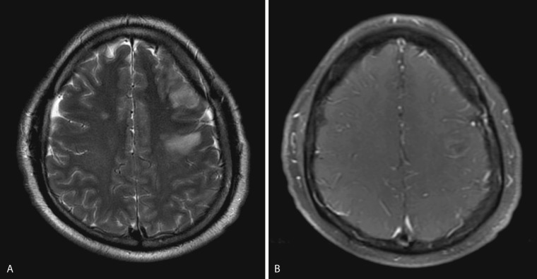 FIG 10-5, Early cerebritis. A, T2-weighted image demonstrates two ill-defined areas of high signal intensity involving the cortex and subcortical white matter of the left frontal lobe. B, Gadolinium-enhanced MRI study shows mild ill-defined peripheral enhancement. Subsequent imaging (not shown) demonstrated formation of two mature abscesses in these areas.