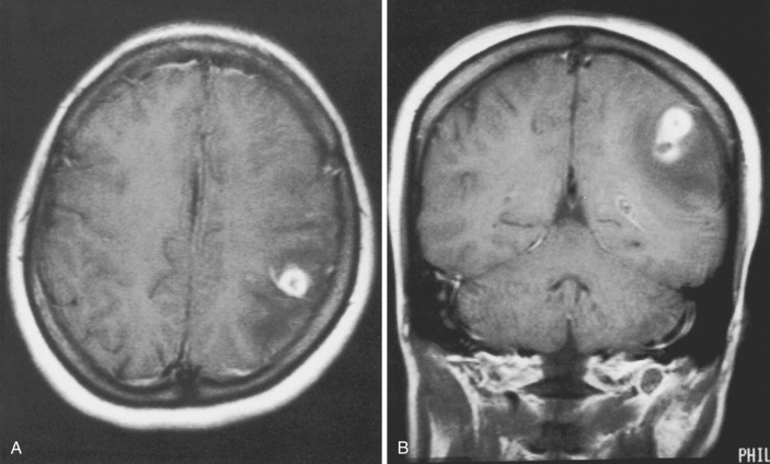 FIG 10-6, Late cerebritis. A, Gadolinium-enhanced MRI study shows thick, smooth, ringlike enhancement with surrounding edema. B, Gadolinium-enhanced MRI study (coronal view) shows a second small adjacent ringlike enhancement.