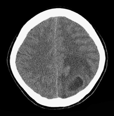 FIG 10-7, Mature abscess. Noncontrast CT demonstrates a central hypodense cavity with an iso- to slightly hyperdense rim and surrounding edema.