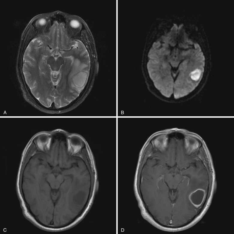 FIG 10-8, Mature abscess. A, T2-weighted image shows a mature abscess with a hypointense rim, central cavity, and adjacent surrounding edema. B, Diffusion-weighted image demonstrates internal high signal intensity. Corresponding ADC images (not shown) demonstrated low values representing diffusion restriction. C, T1-weighted image demonstrates hypointense central cavity with iso- to hyperintense rim. D, T1-weighted postcontrast image demonstrates smooth ringlike enhancement corresponding to the hypointense rim seen on T2-weighted image.