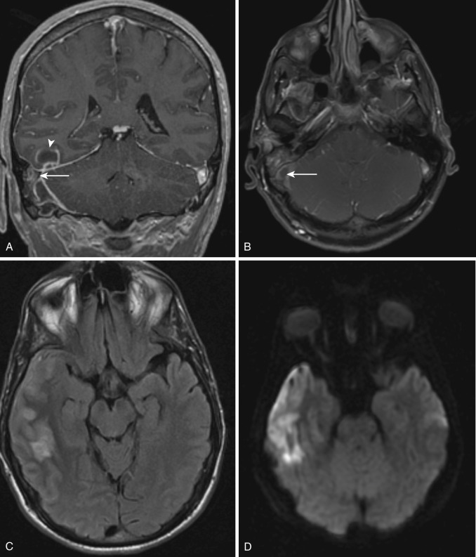 FIG 10-9, Mastoiditis causing meningitis, subdural empyema, cerebritis, thrombophlebitis, and abscess. A and B, T1-weighted postcontrast coronal and axial images demonstrate enhancement in the right mastoid bone and central filling defect with peripheral enhancement in the adjacent sigmoid sinus (arrow). Coronal image demonstrates rim enhancing abscess in the adjacent inferior temporal lobe (arrowhead). C, T2-FLAIR image demonstrates right temporal subdural, sulcal, cortical and subcortical hyperintensity due to meningitis, subdural empyema, cerebritis, and abscess formation. D, Diffusion-weighted image demonstrates ill-defined temporal lobe hyperintensity representing cerebritis. There is also focal diffusion restriction in the posterior right temporal lobe corresponding to a rim enhancing abscess on postcontrast images. Anterior temporal convexity subdural empyema also shows diffusion restriction.