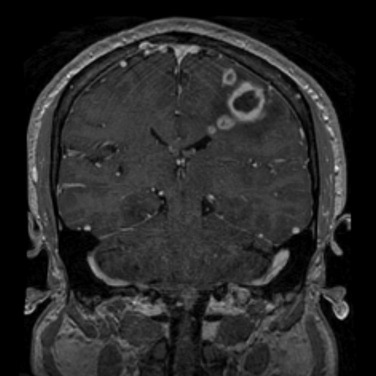 FIG 10-10, Mature abscess with daughter abscesses. Coronal postcontrast T1-weighted image demonstrates a large ring enhancing lesion with surrounding hypointense edema and multiple adjacent small ring enhancing lesions.