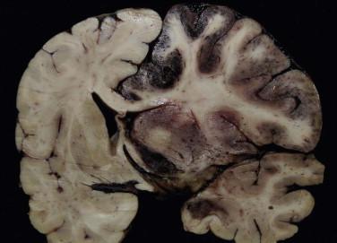 Fig 2, Ischemic cerebrovascular disease. A massive right cerebral infarct (recent) resulted in hyperemia, swelling, and right cingulate gyrus herniation.