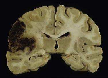 Fig 3, Ischemic cerebrovascular disease. Hemorrhagic infarct in left middle cerebral artery distribution. Hemorrhagic infarction is usually the result of embolic occlusion of a cerebral artery.