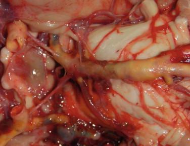 Fig 5, Cerebral atherosclerosis. The basal view shows the typical yellow appearance of atherosclerotic basilar ( right ) and internal carotid ( left ) arteries.