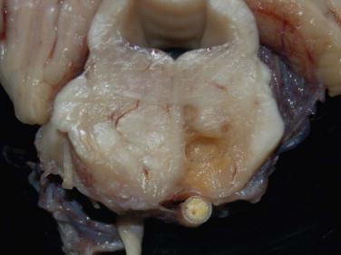 Fig 6, Cerebral atherosclerosis. Occlusive atherosclerotic disease of the basilar artery has resulted in remote cavitation (infarction) of the right basis pontis.