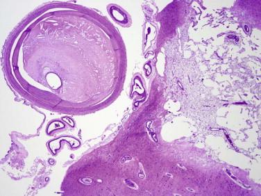 Fig 7, Cerebral atherosclerosis. A microscopic image from Figure 6 shows the basilar artery ( upper left ) with extensive fibrointimal plaque formation that is associated with an area of remote infarction (cavitation) ( right ).