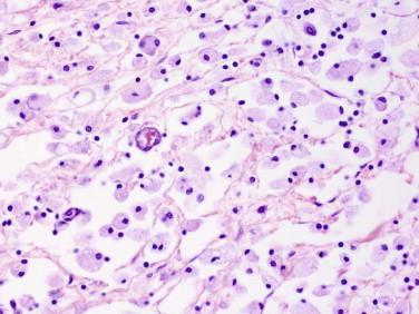 Fig 9, Organizing cerebral infarct (days to weeks after ischemia). Abundant foamy macrophages engulf and remove necrotic brain tissue.