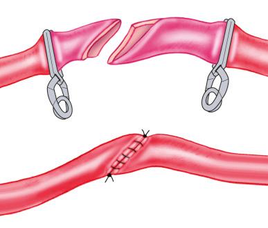 Figure 21.1, End-to-end anastomosis.