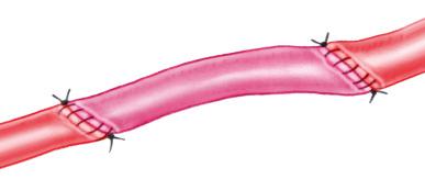 Figure 21.2, A short interposition graft has been used since the arterial ends cannot be approximated without tension.