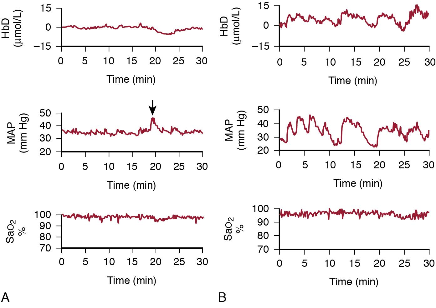 Fig. 2.4, Intact and compromised cerebral blood flow (CBF) autoregulation in VLBW neonates in the immediate postnatal period. Changes in cerebral intravascular oxygenation (HbD = HbO 2 – Hb) correlate with changes in CBF (5). A, Changes in HbD (i.e., CBF), mean arterial pressure (MAP), and oxygen saturation (SaO 2 ) in a 1-day-old 28-week gestation preterm infant whose subsequent head ultrasound remained normal. No change occurs in CBF in relation to the sudden increase in MAP associated with endotracheal tube suctioning ( arrow ). B, Changes in HbD (CBF), MAP, and SaO 2 in a 1-day-old 27-week GA preterm infant whose subsequent head ultrasound revealed the presence of PWMI. Changes in blood pressure are clearly associated with changes in CBF.