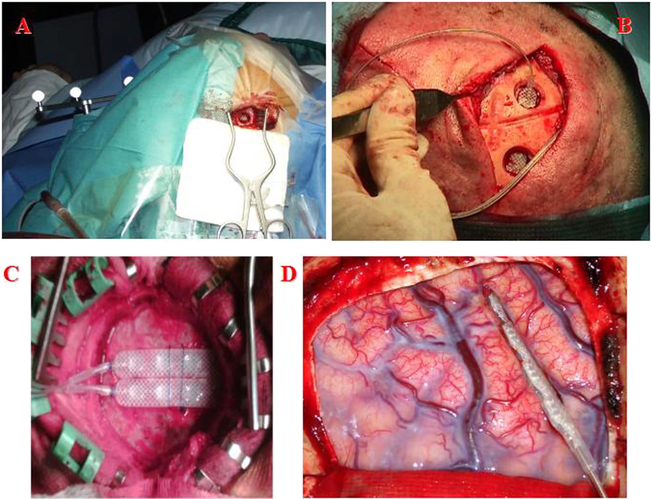 Figure 2.1, Methods of implantation of stimulating paddles for invasive cortical stimulation: (A): single burr hole; (B): two burr holes; (C): flap craniotomy; (D): subdural approach.