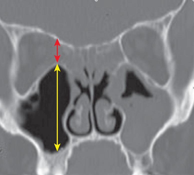 Fig. 30.1, A relatively short height of the ethmoid sinus (top arrow) as a result of a highly pneumatized tall maxillary sinus (bottom arrow).