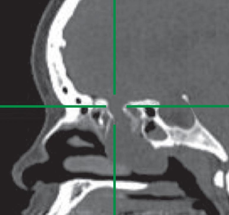 Fig. 30.3, Large encephalocele of the ethmoid skull base. Crosshairs localize the bony skull base defect.