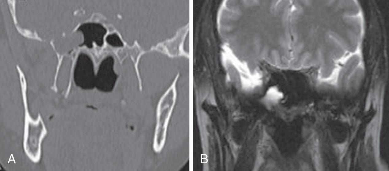 Fig. 30.4, CT (A) and MRI (B) of meningocele protruding into the lateral recess of the right sphenoid sinus.