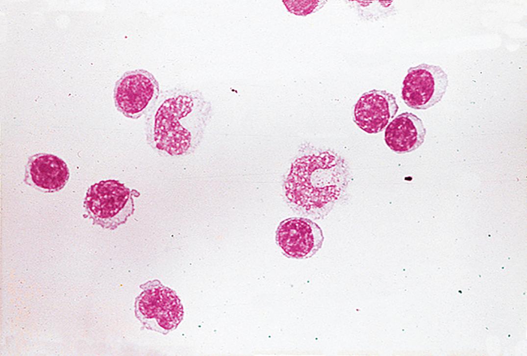 Figure 30.1, Cerebrospinal fluid cytology (lymphocyte to monocyte distribution ratio 70:30).