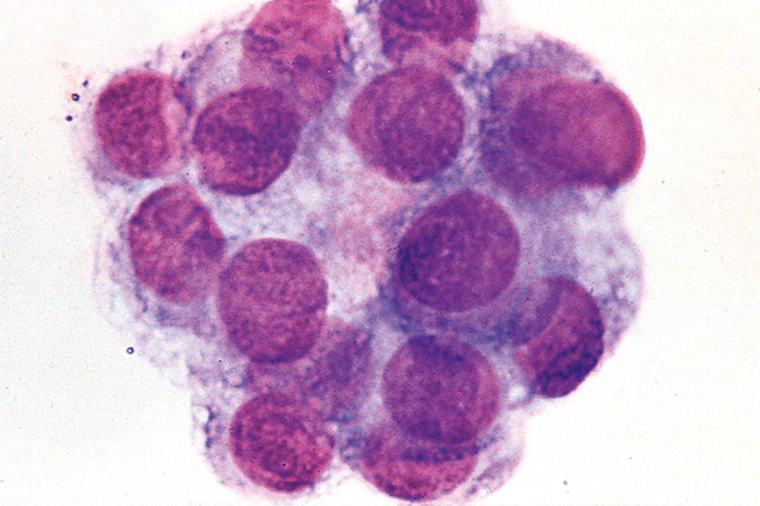 Figure 30.2, Choroid plexus cells in cerebrospinal fluid.