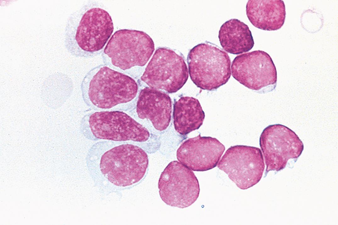 Figure 30.3, Cluster of blastlike cells in cerebrospinal fluid from a premature newborn.