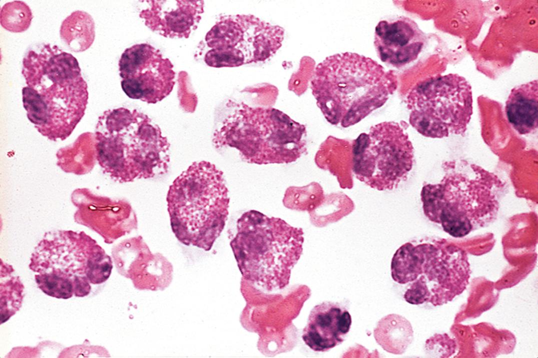 Figure 30.4, Eosinophils in cerebrospinal fluid from a child with a malfunctioning ventricular shunt.