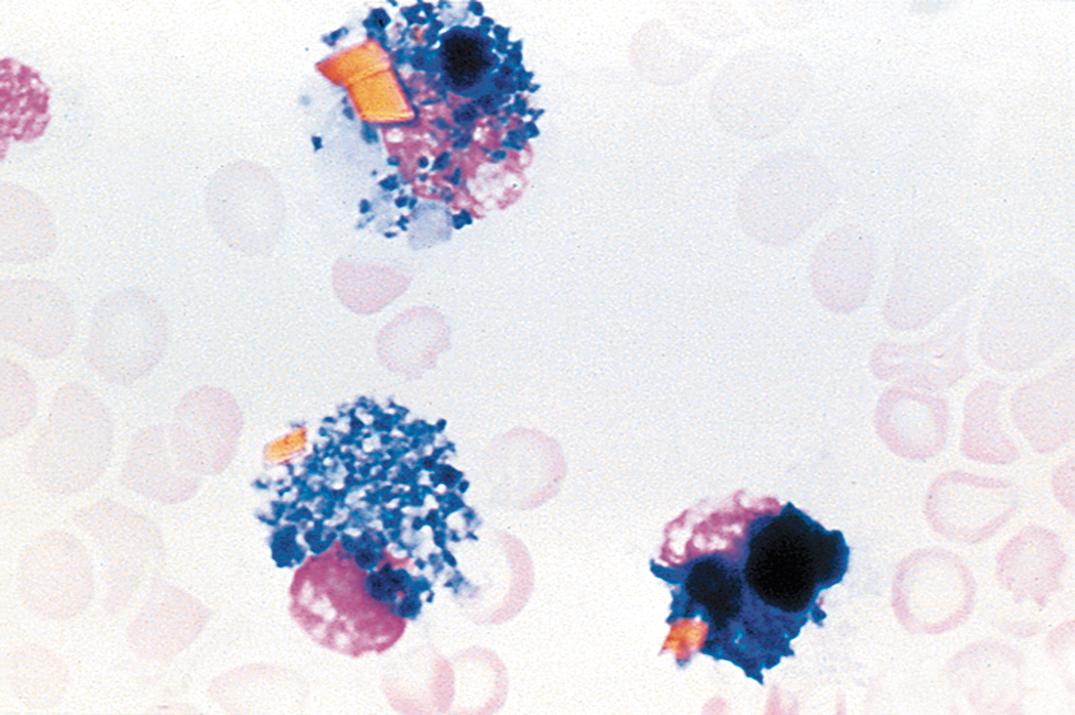 Figure 30.5, Hemosiderin-laden macrophages (siderophages) from the cerebrospinal fluid of a patient with a subarachnoid hemorrhage. Hemosiderin crystals (golden-yellow) are also present.