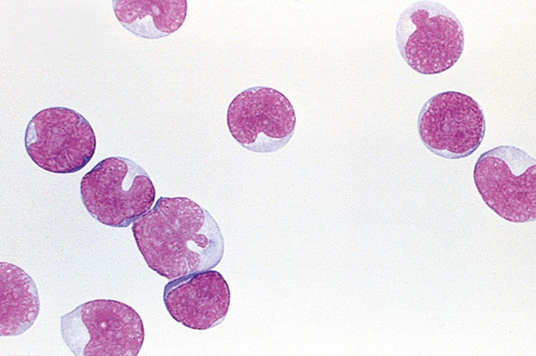 Figure 30.6, Acute lymphoblastic leukemia in cerebrospinal fluid. Note the uniformity of the blast cells.