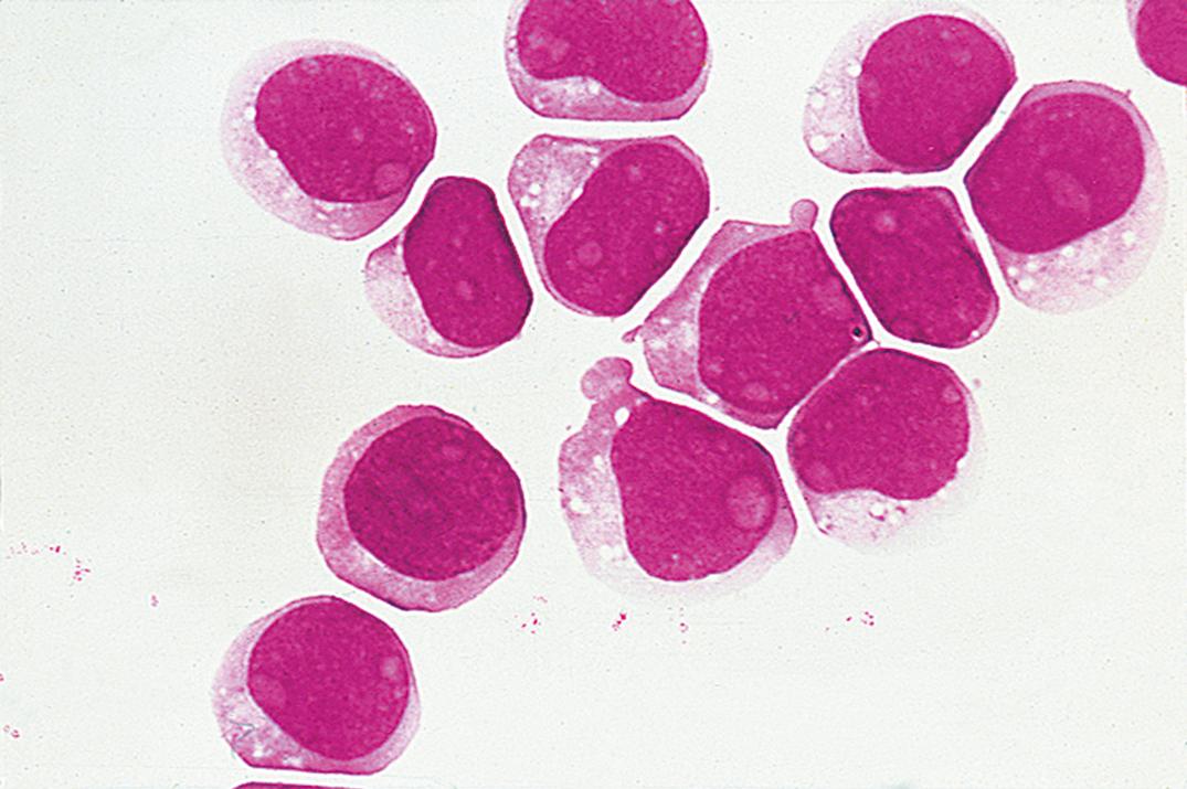 Figure 30.7, Acute myeloid leukemia in cerebrospinal fluid.