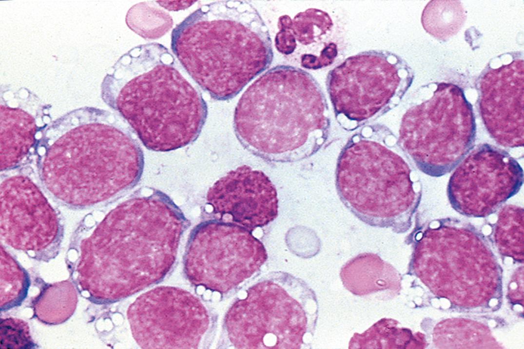 Figure 30.8, Burkitt lymphoma in cerebrospinal fluid. The cells are characterized by blue cytoplasm with vacuoles and a slightly clumped chromatin pattern.
