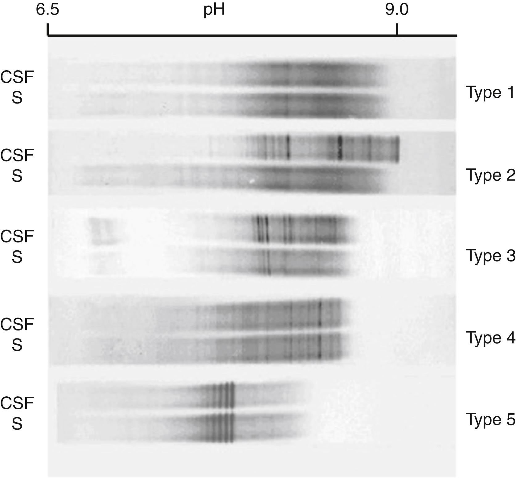 Figure 30.9, Immunoglobulin G isoelectric focusing (IgG-IEF) analysis of cerebrospinal fluid (CSF) illustrating the different patterns seen in paired CSF and serum (S) samples from patients with multiple sclerosis (MS) and other conditions. The 5 classic patterns are: Type 1, no bands in CSF or S samples; Type 2, oligoclonal IgG bands in CSF and none in the S sample, indicative of intrathecal IgG synthesis; Type 3, oligoclonal bands in CSF (like Type 2) and additional identical oligoclonal bands in CSF and S samples, still indicative of intrathecal IgG synthesis; Type 4, identical oligoclonal bands in CSF and S samples, indicative of a systemic and not intrathecal immune reaction with a normal or abnormal blood–CSF barrier and passive transfer of oligoclonal bands from S to CSF; and Type 5, identical monoclonal bands in CSF and S samples, indicative of the presence of a paraprotein (monoclonal IgG component).