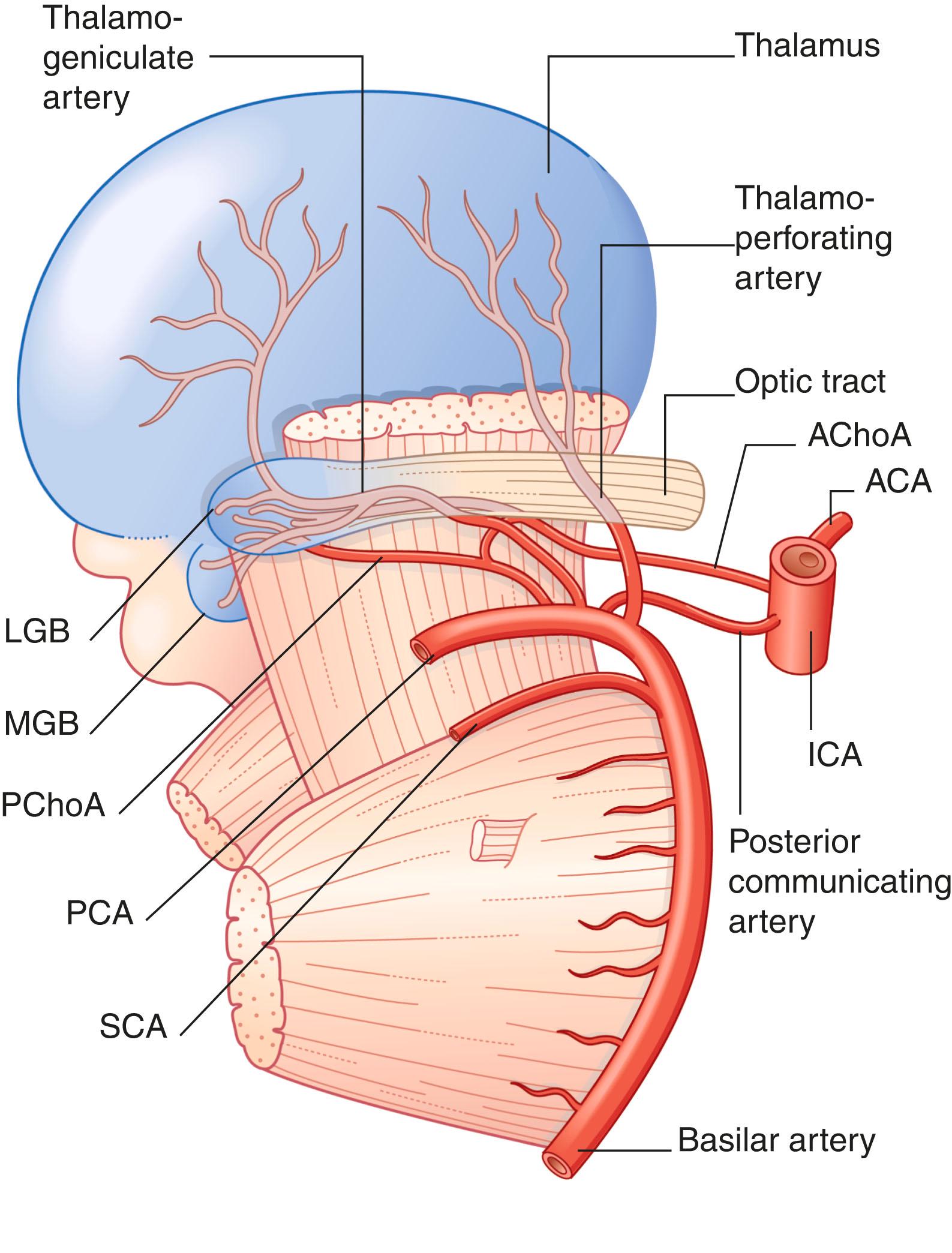 Fig. 35.5, Central branches of the posterior cerebral artery (PCA) . Although only two arteries are shown, each in fact comprises several branches from the PCA. The thalamoperforating artery shown pierces the posterior perforated substance and supplies the anterior one-third of the thalamus. The thalamogeniculate artery shown supplies the geniculate bodies and the posterior two-thirds of the thalamus. ACA , Anterior cerebral artery; AChoA , anterior choroidal artery; ICA , internal carotid artery; LGB , lateral geniculate body; MGB , medial geniculate body; PChoA , posterior choroidal artery; SCA , superior cerebellar artery.