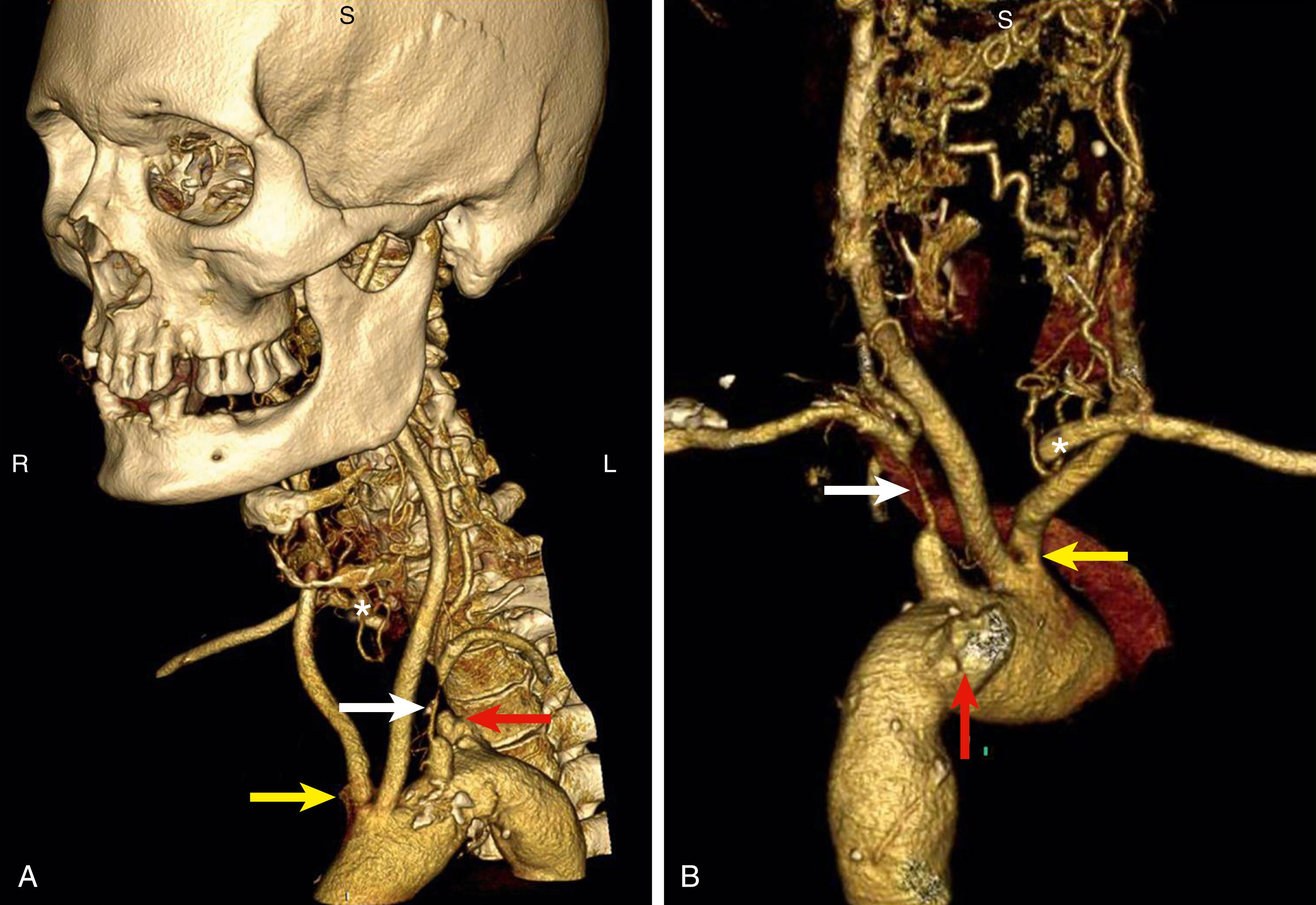 Figure 91.1, Multidetector computed tomographic angiography showing an unexpected anomaly of the great vessels of the aortic arch. ( A ) Arch viewed from its anterior aspect. ( B ) Arch viewed from its posterior aspect. Both common carotid arteries arise from a joint origin (yellow arrow) , and there is a long, severe stenosis of the proximal left subclavian artery (white arrow) . The right subclavian artery arises from an aberrant position and is occluded just beyond its origin (red arrow) with refilling distally (asterisk) . The red arrow marks the “diverticulum of Kommerl.”