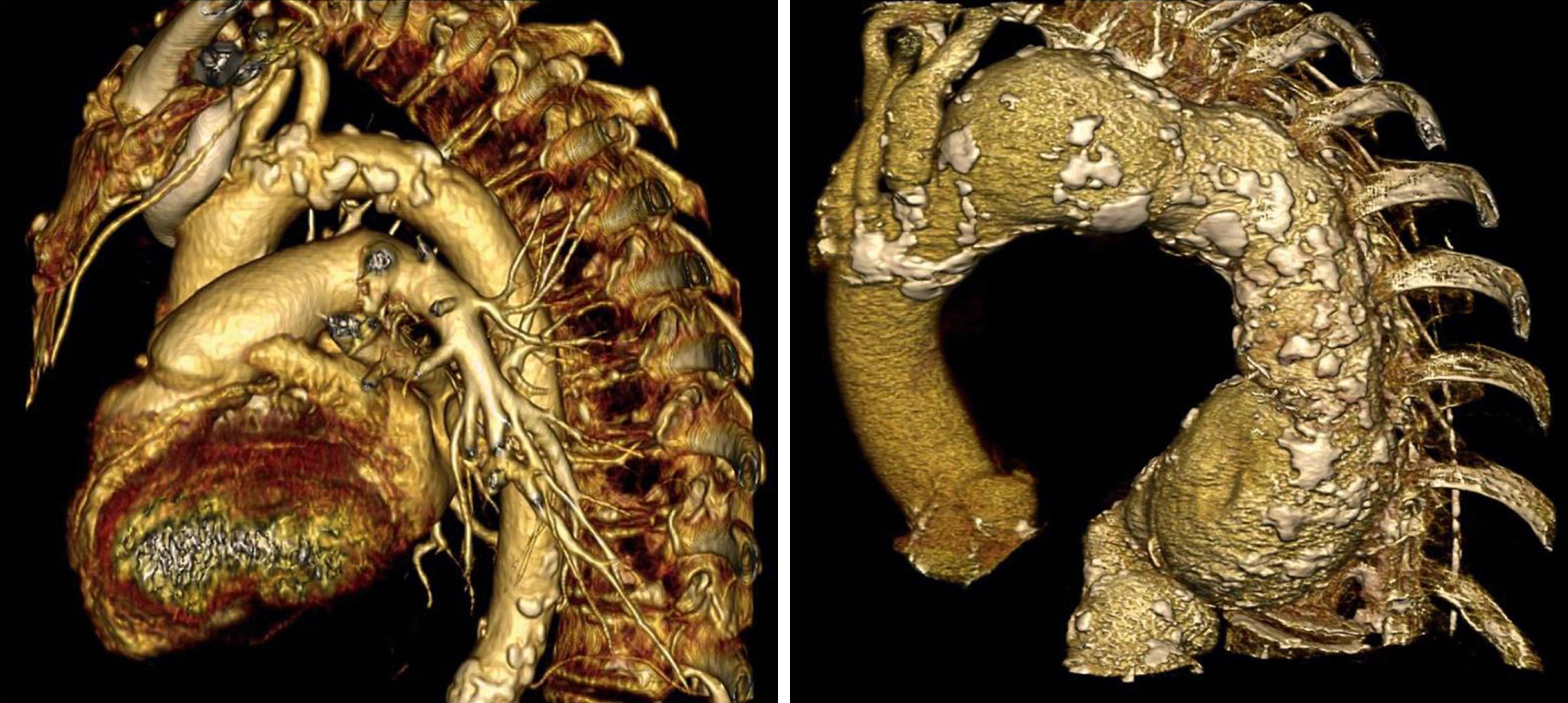 Figure 91.2, Volume rendition multidetector computed tomographic angiography showing calcification in the thoracic aorta, aortic arch, and origins of the great vessels.