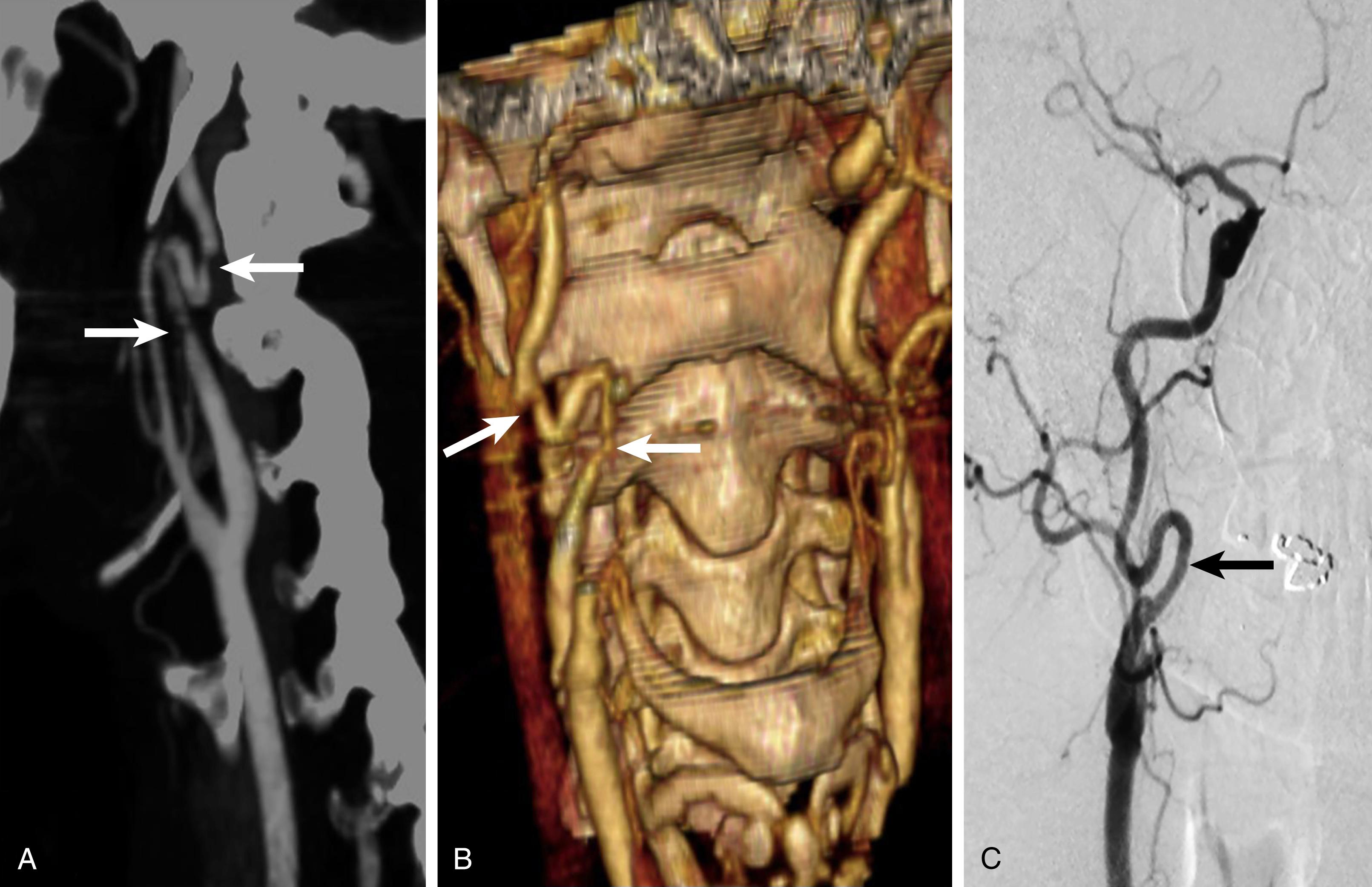 Figure 91.3, Image processing in patients with distal internal carotid artery (ICA) loops can lead to the creation of artifacts that can be interpreted as clinically important stenoses. ( A ) Multidetector computed tomographic angiography (MDCTA) maximum intensity projection; note the normal bifurcation and a distal looped ICA with apparent inflow and outflow stenoses ( arrows ). ( B ) Three-dimensional MDCTA in the same patient suggesting that the stenoses were real ( arro ws). ( C ) Selective intraarterial digital subtraction arteriography showing the looped ICA (arrow) but no stenoses. The “stenoses” identified on A and B were caused during image processing.