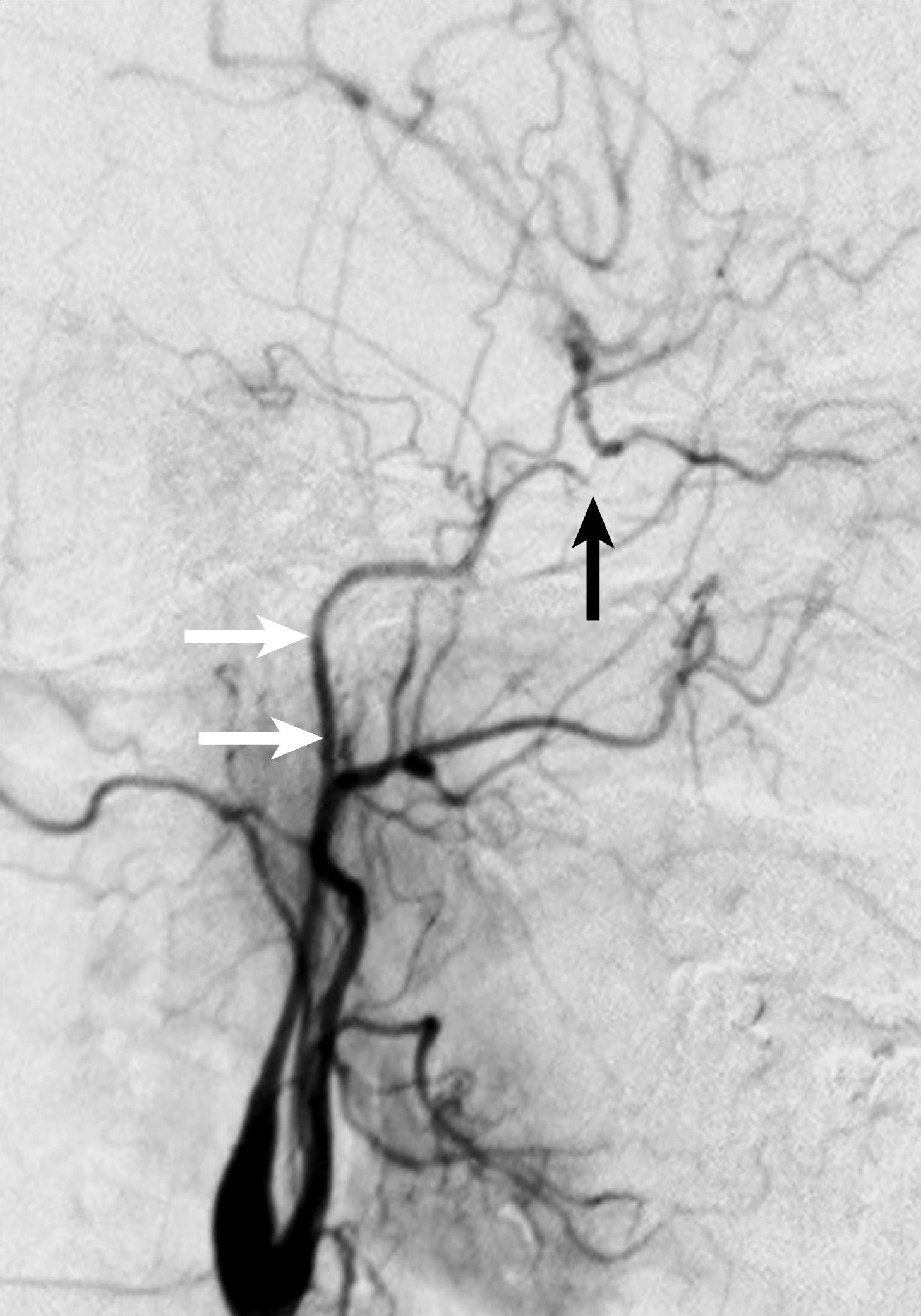 Figure 91.4, Selective intraarterial digital subtraction arteriography (IADSA) in a 38-year-old woman with stroke (middle cerebral territory infarct on computed tomography scan). Duplex ultrasound showed slow, high-resistance flow in the carotid artery but a normal bifurcation. Contrast-enhanced magnetic resonance angiography suggested a subocclusion but could not image the distal internal carotid artery (ICA). This delayed IADSA image shows a normal-caliber carotid bifurcation with a narrow-caliber ICA in its midsection ( white arrows where flow was extremely slow). In the very distal ICA (black arrow) , vessel diameter dwindles toward complete occlusion. The images are probably consistent with acute dissection and compression of the true lumen by thrombus in the false lumen.