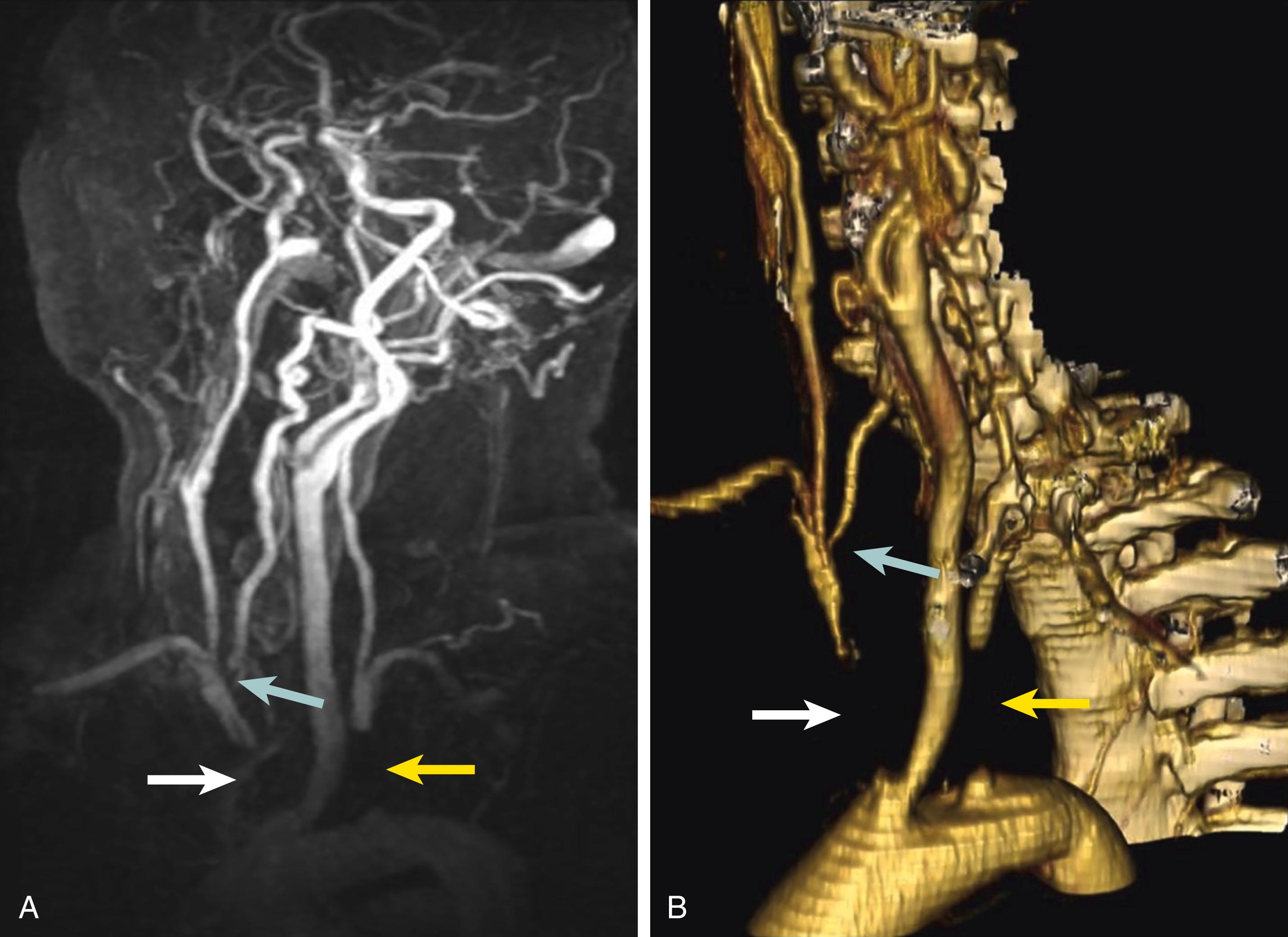 Figure 91.5, Sixty-year-old female with a vertebrobasilar stroke and recurring unsteadiness of gait imaged by contrast-enhanced magnetic resonance angiography (CEMRA; A ) and multidetector computed tomographic angiography (MDCTA; B ). There is complete occlusion of the innominate artery (white arrow) and left subclavian artery (yellow arrow) . The right vertebral artery has a stenosis at its origin (blue arrow) . CEMRA and MDCTA have shown identical features, but MDCTA is easier to interpret because of venous contamination in the CEMRA image.