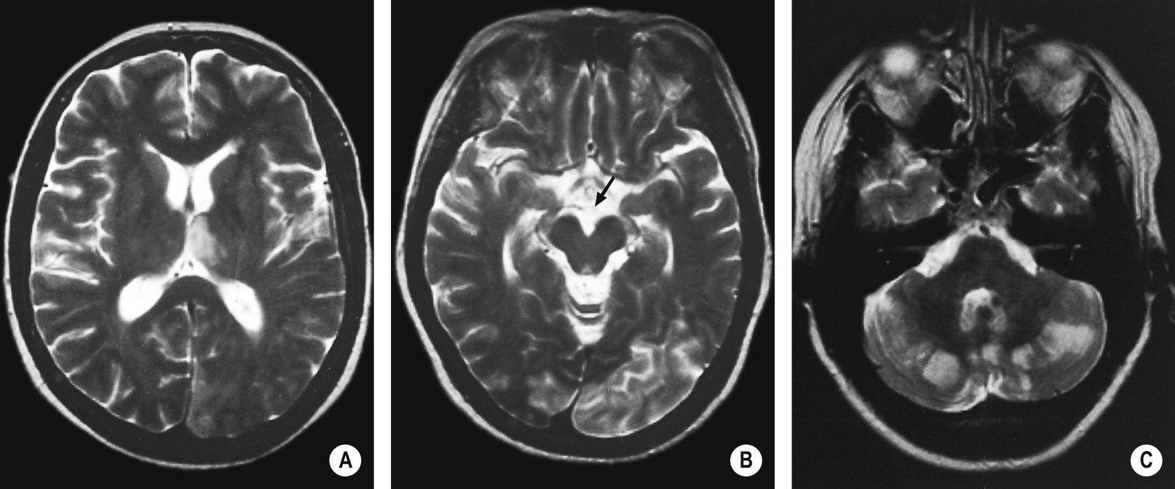 ‘Top of the basilar’ syndrome. T2WI shows multiple infarcts in the basilar and posterior cerebral artery territories including the left thalamus (A), both occipital lobes (B) and cerebellar hemispheres (C). Note the absence of flow void in the distal basilar artery in B (arrow). *