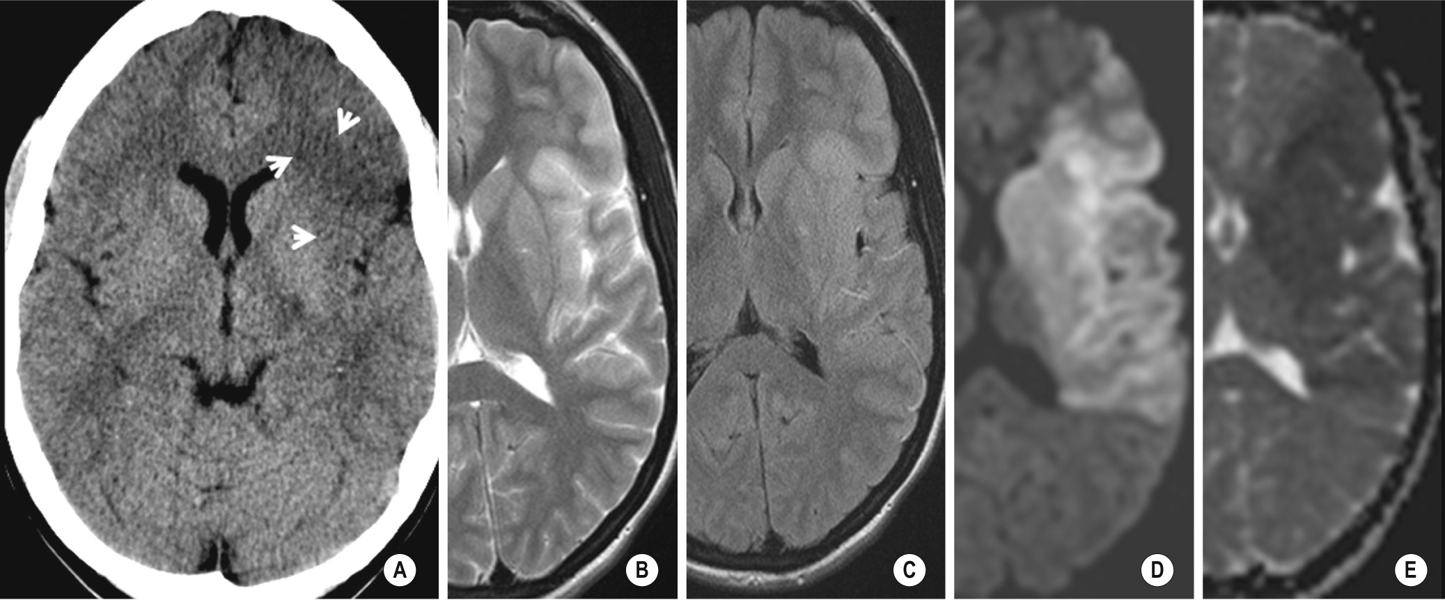An acute left MCA territory infarct presenting 7 h after onset is visible on CT (A) as low attenuation in the left frontal operculum and left insula. At this stage, not only is the infarct shown as T2 hyperintensity and gyral swelling but also more extensive involvement of the left MCA territory is identified on T2-weighted and FLAIR imaging (B, C). However, the full extent of involvement—including the basal ganglia—is only clearly demonstrated on DWI (D) as hyperintensity and on the corresponding ADC map (E) as hypointensity. **