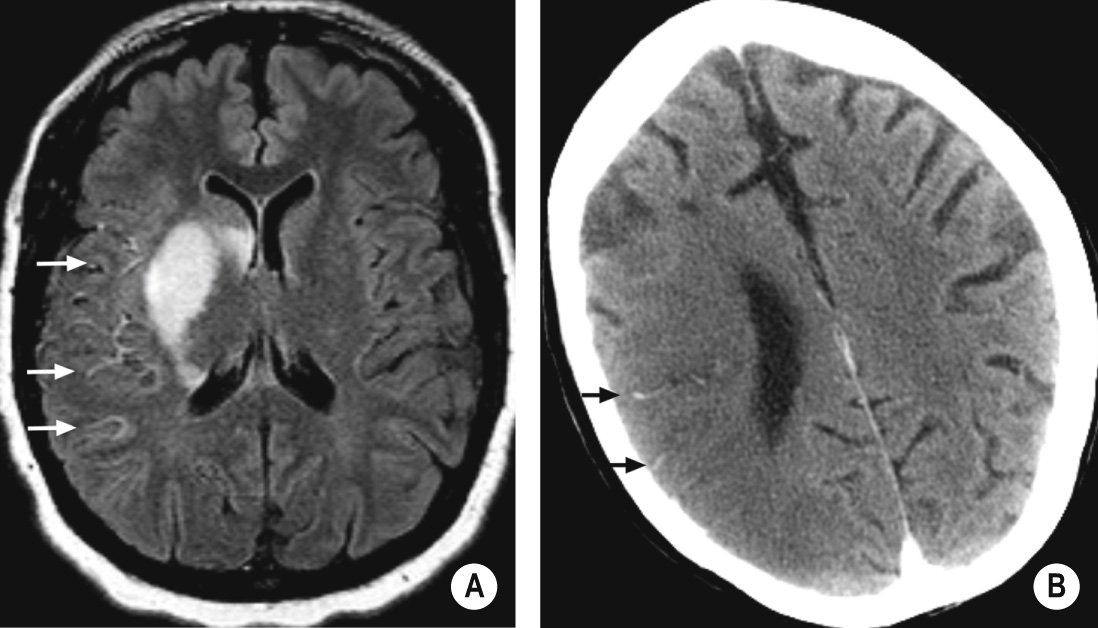 Vascular signs in acute infarcts. (A) FLAIR axial image of an acute right striatocapsular infarct. Note asymmetrical high signal returned from patent right MCA cortical branches due to compromised flow (arrows). (B) CECT shows early infarct changes of mild low density and local swelling in posterior part of right MCA territory. There is asymmetrical enhancement of MCA cortical branches because of sluggish flow (arrows). *